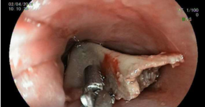 Bé trai 3 tuổi bị xương cá đâm thủng ruột