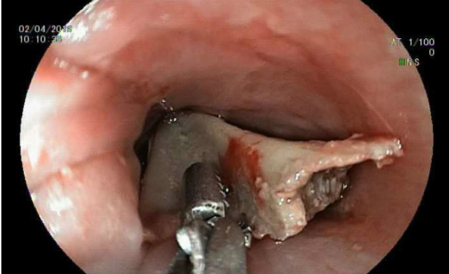 Bé trai 3 tuổi bị xương cá đâm thủng ruột Bé trai 3 tuổi bị xương cá đâm thủng ruột